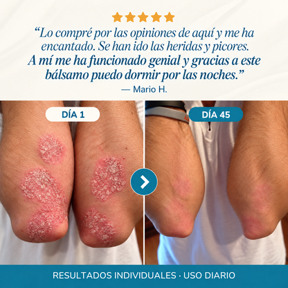 Bálsamo Reparador para Psoriasis y Eccema