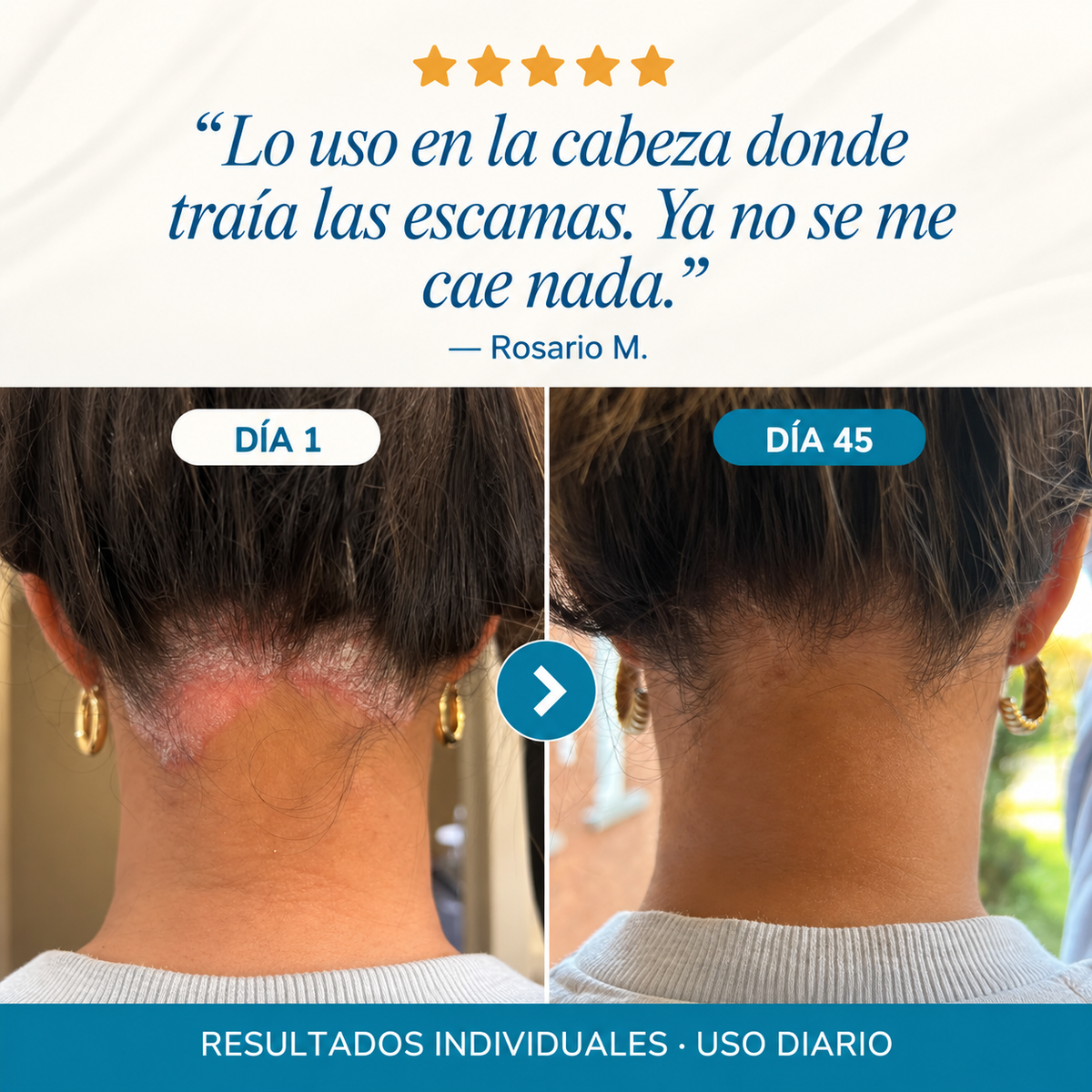 Bálsamo Reparador para Psoriasis y Eccema