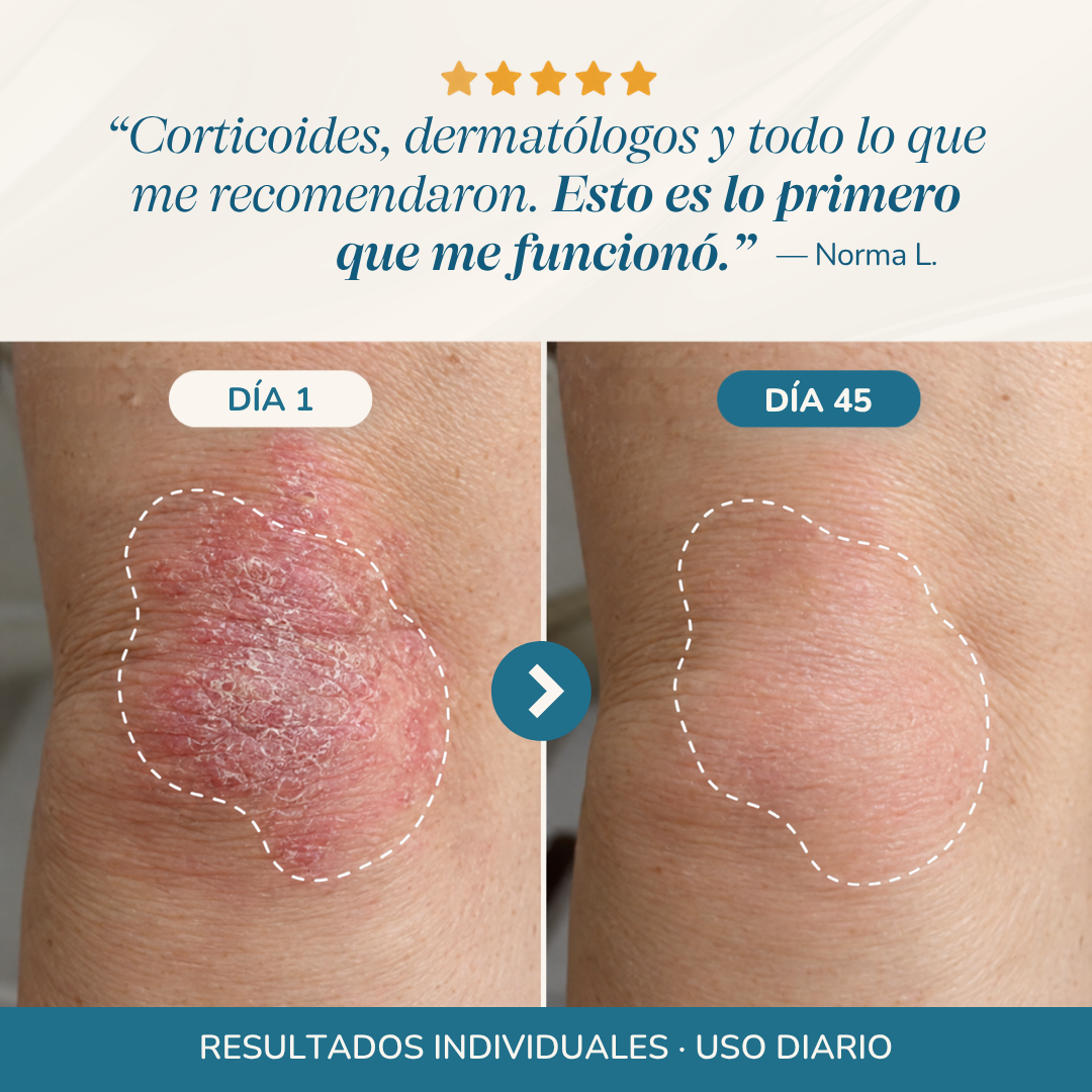 Bálsamo Reparador para Psoriasis y Eccema