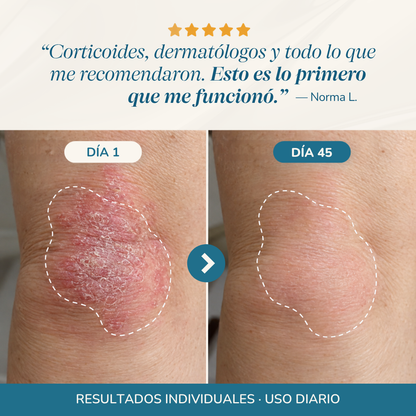 Bálsamo Reparador para Psoriasis y Eccema
